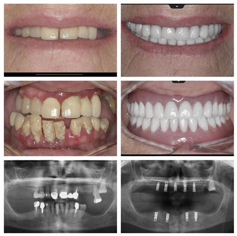 dental implants for multiple teeth oxford